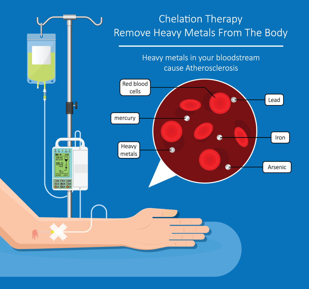 Chelation Therapy - NYCIM